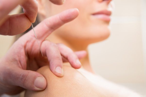 Dry needling